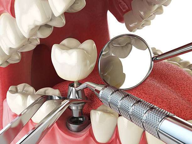 Best Emergency Broken Tooth Repair in Caseyvle, IL